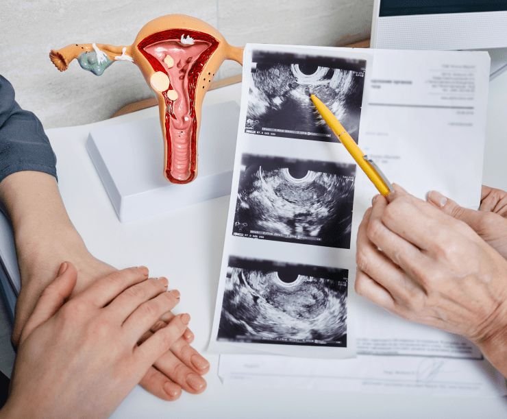 Endometriosis